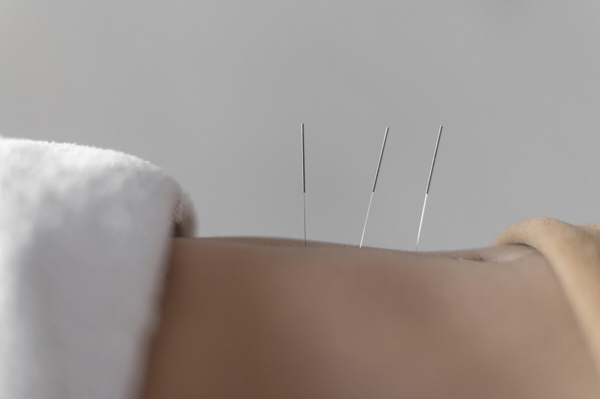 Acupuncture — Practitioner's Hand